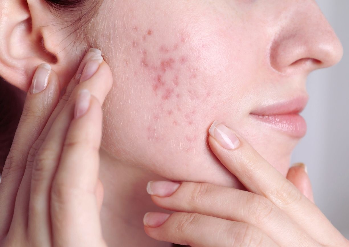 femme ayant de l'acné sur le visage