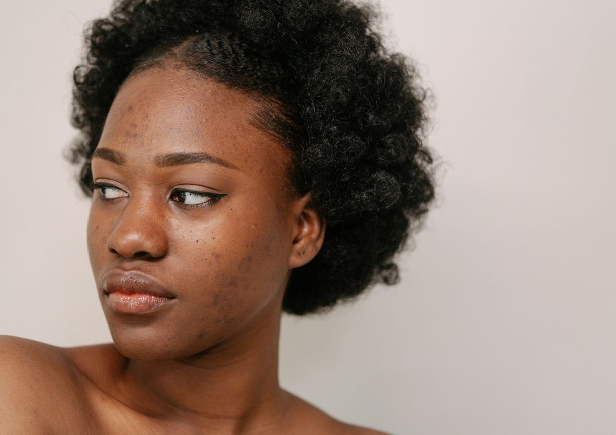 femme ayant la peau noire présentant des taches pigmentaires sur le visage