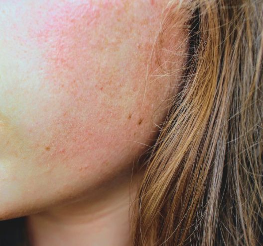 Le double nettoyage peut provoquer des rougeurs