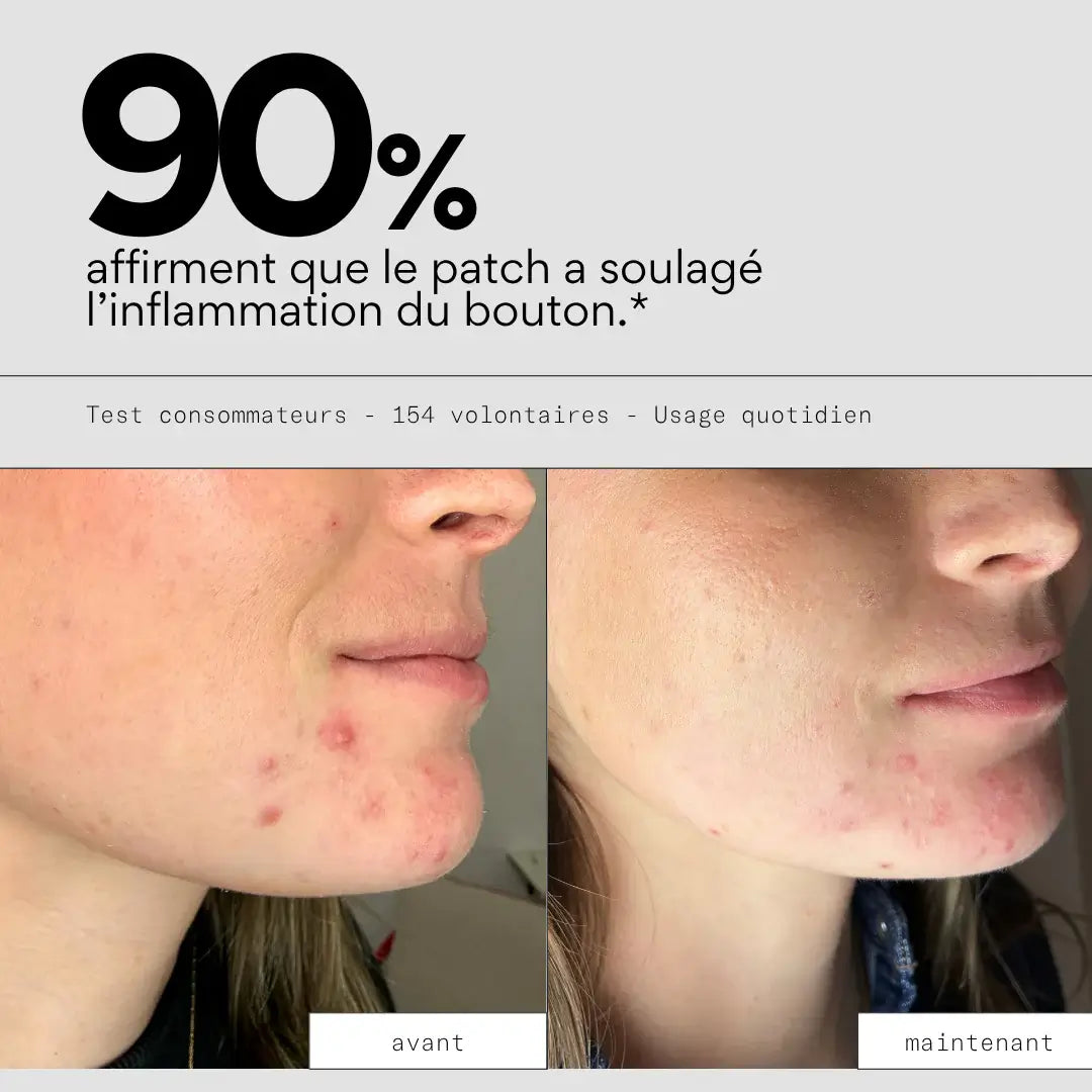 patchs visage stop boutons taille XL Skin & Out test consommateur