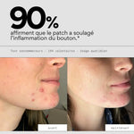 patchs visage stop boutons taille XL Skin & Out test consommateur