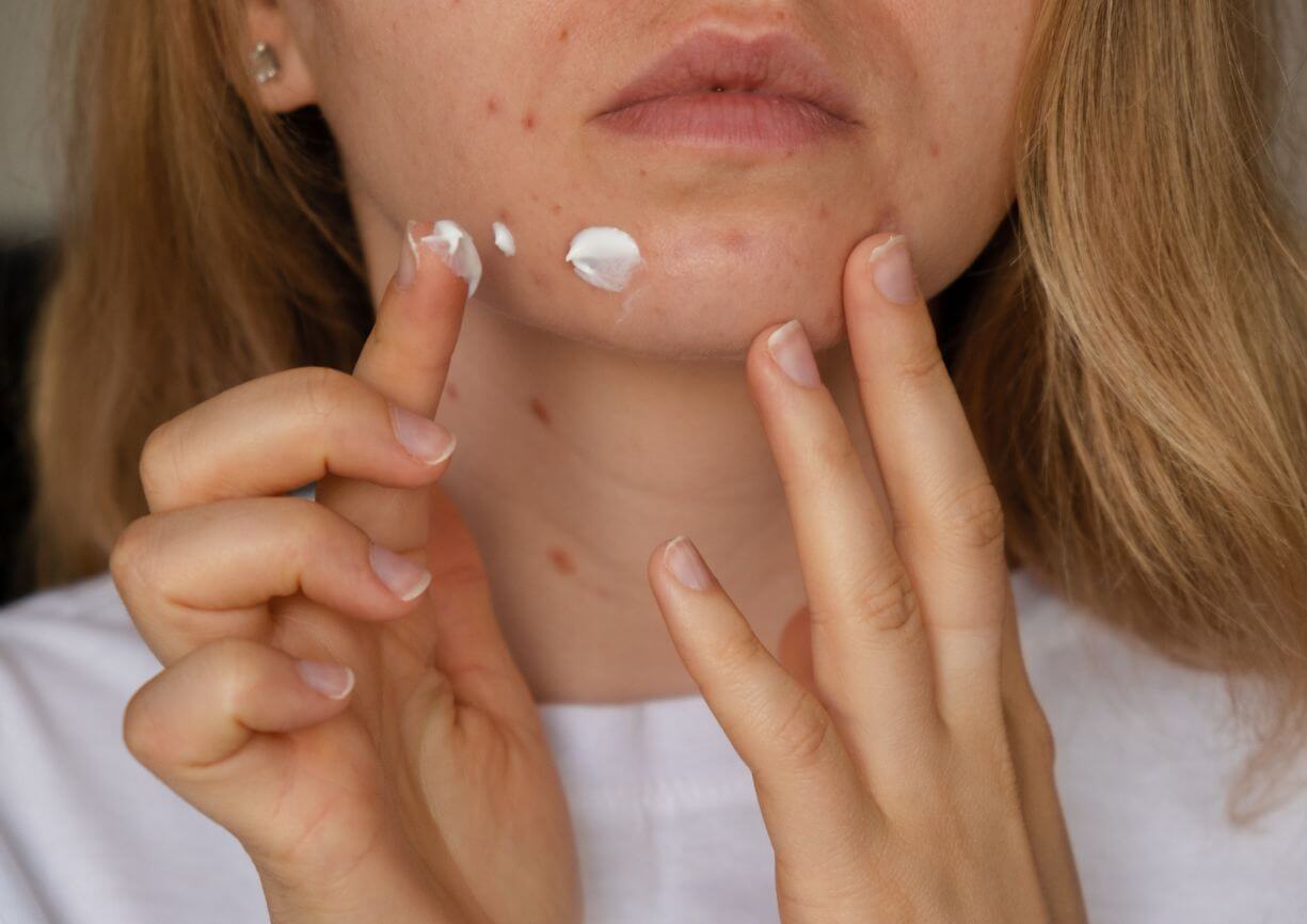 Trouver le meilleur actif anti-imperfections pour sa peau.