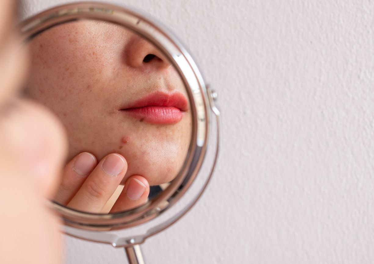 Femme regardant un microkyste sur son visage