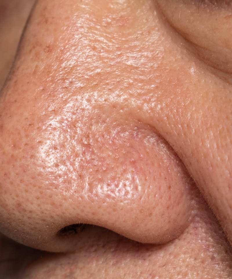 Zoom sur le nez et les joues d'une personne ayant la peau mature et des pores visibles